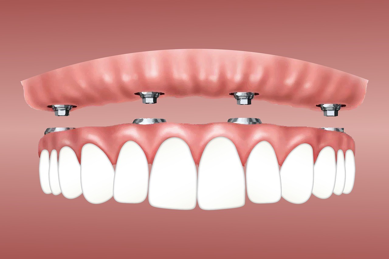 The Differences Between Dental Implants and Dentures